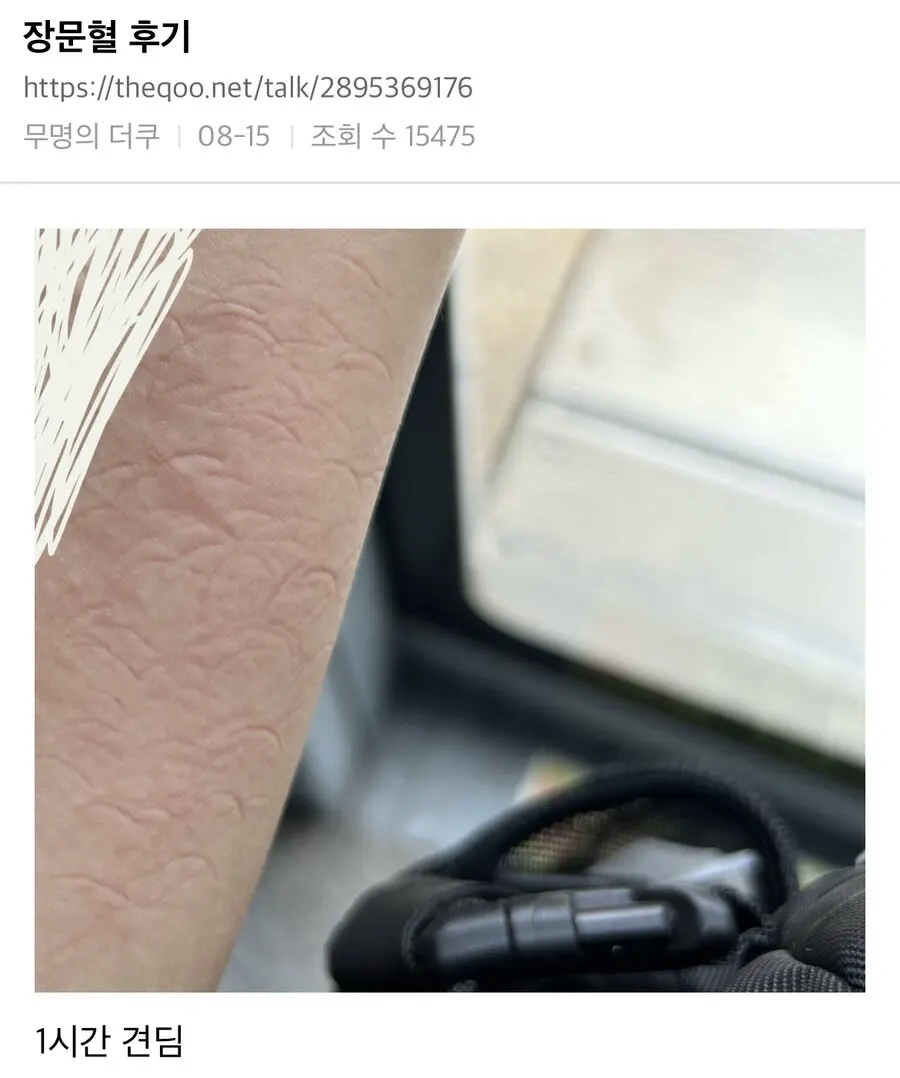 급똥 막는 혈 후기 | mbong.kr 엠봉