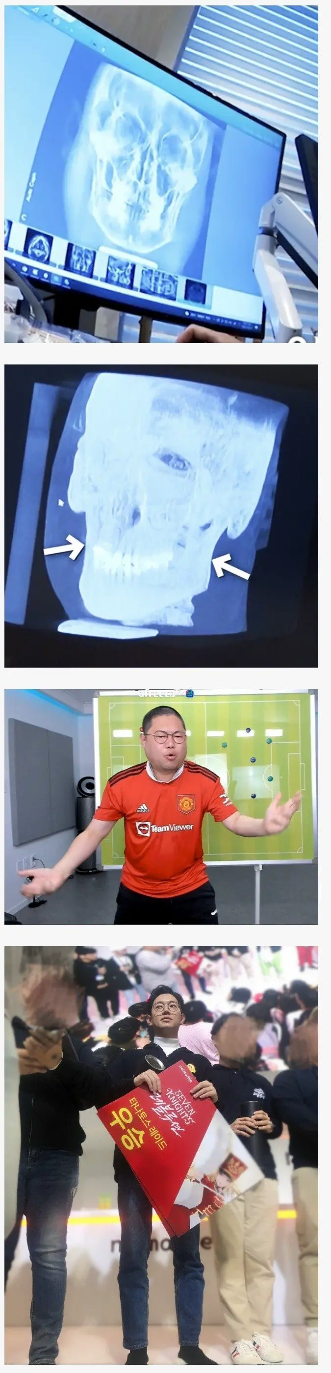 감스트 얼굴 엑스레이 뼈와 살 | mbong.kr 엠봉