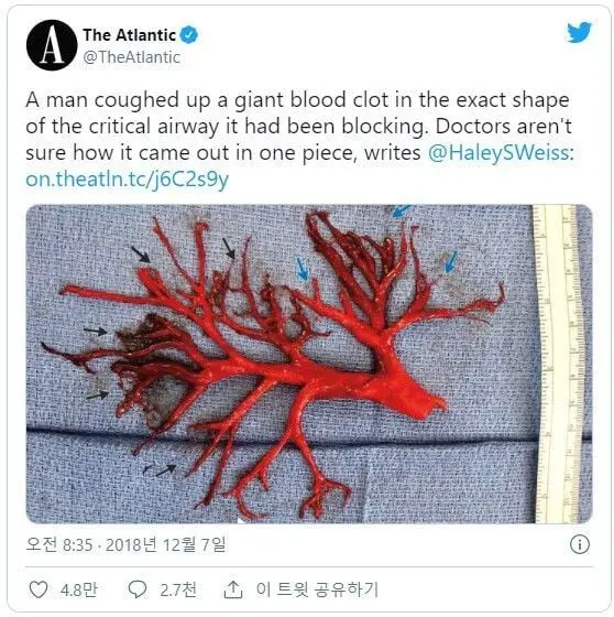 약혐) 몸 속에서 붉은 산호가 나온 남자 ㄷㄷㄷㄷㄷ | mbong.kr 엠봉