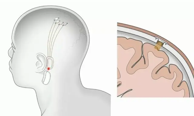 인간의 뇌에 칩 이식한 뉴럴링크의 첫 수술 근황 | mbong.kr 엠봉
