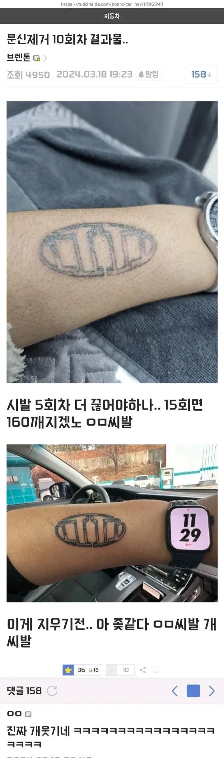 문신제거 10회차 결과물 | mbong.kr 엠봉