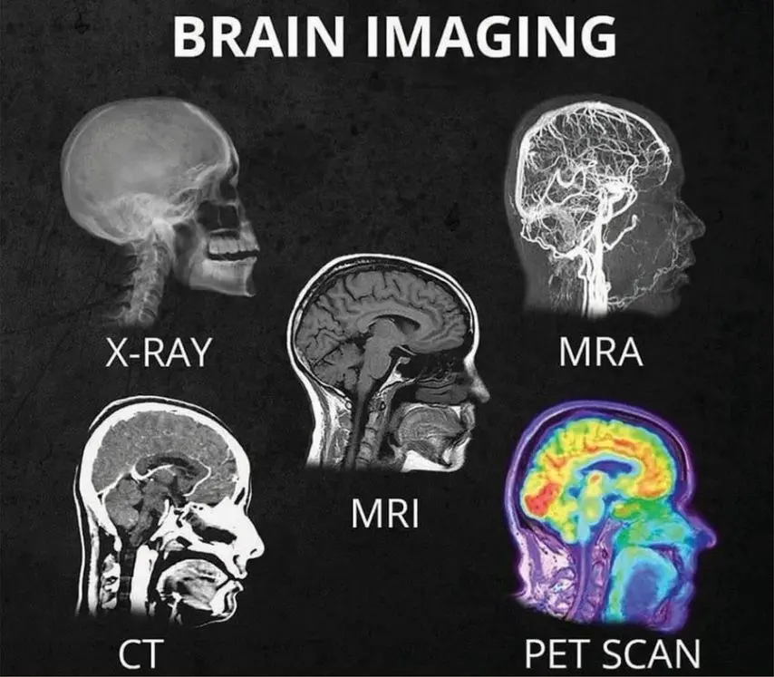 촬영 방법에 따른 다섯가지 뇌 이미지 | mbong.kr 엠봉
