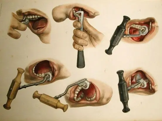 옛날 치의학 도구들 | mbong.kr 엠봉