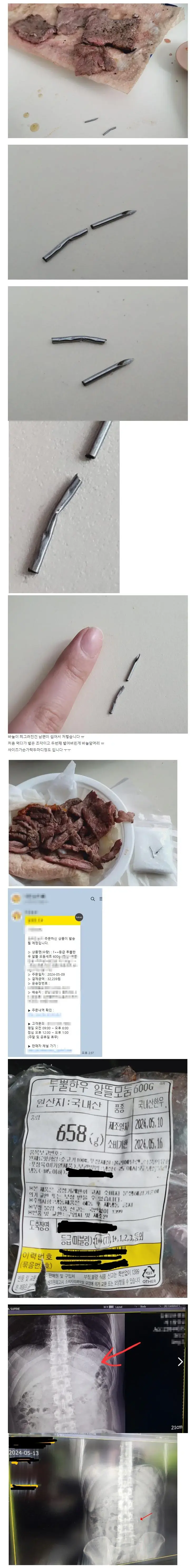 소고기 먹다가 주사바늘 삼켜버린 남편 ㄷㄷㄷ | mbong.kr 엠봉