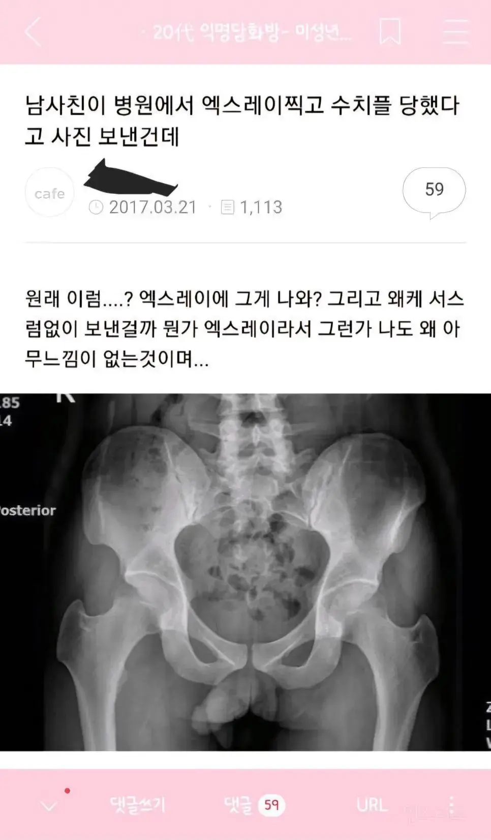 골반 엑스레이 찍고 수치플 당한 남사친.jpg | mbong.kr 엠봉