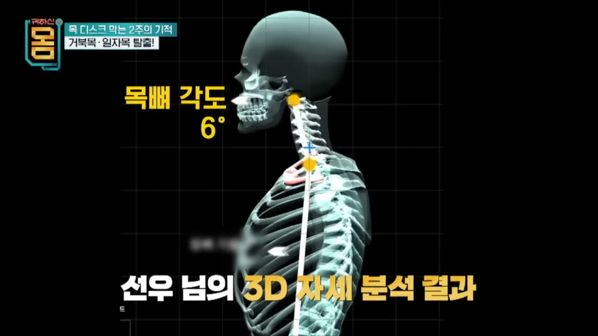 2주만에 효과 대박인 거북목•일자목 마사지&운동 | mbong.kr 엠봉