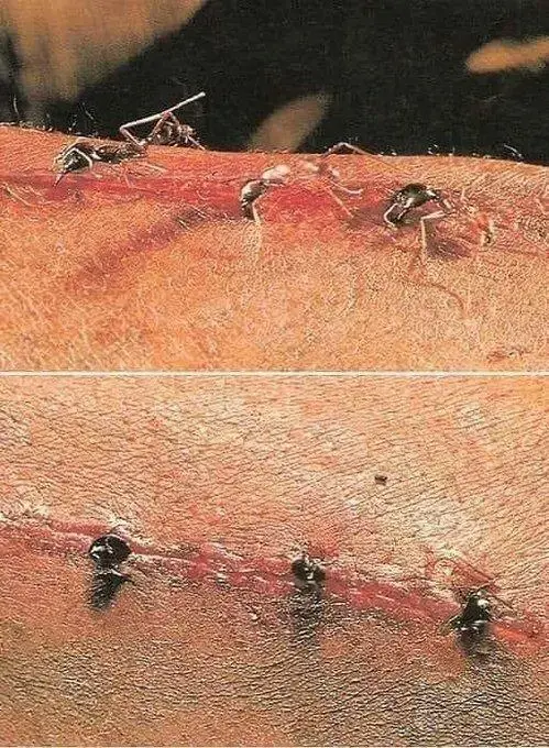 [혐] 개미로 봉합수술 하는 방법.gif | mbong.kr 엠봉