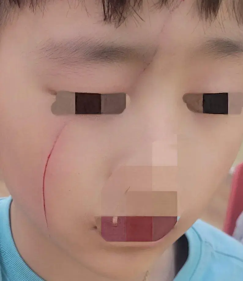 초딩 4학년이 연필로 얼굴 그어놓음 ㅎㄷㄷ | mbong.kr 엠봉