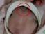 "제왕절개로 낳은 딸 얼굴에 칼자국"…병원 대응에 부모 분통